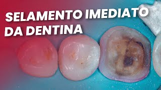 SELAMENTO IMEDIATO DA DENTINA  Mylene e Renato [upl. by Lafleur]