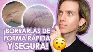 COMO PREVENIR Y BORRAR CICATRICES  Redomendaciones de un dermatólogo [upl. by Juanita]