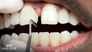 How Tooth Gaps Are Filled  Insider Art [upl. by Subocaj]