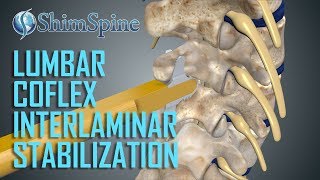 Lumbar Coflex Interlaminar Stabilization Surgery [upl. by Haram235]