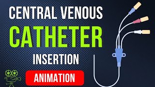 🎬 CENTRAL VENOUS CATHETER CVC INSERTION PROCEDURE  ANIMATED EXPLANATION [upl. by Alyek500]