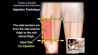 Vastus Lateralis Intramuscular Injection  Everything You Need To Know  Dr Nabil Ebraheim [upl. by Eldreda]