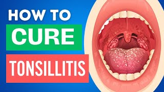 10 Home Remedies for Tonsillitis  Tonsillitis Treatments at Home [upl. by Atekram235]