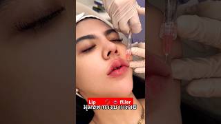 lip filler [upl. by Arza]