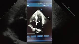 Mitral valve Myxomatous in 2d ECHO [upl. by Ahseka]