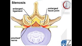 Degenerative Spine 10  Lumbar Canal Stenosis ضيق القناة العصبية القطنية [upl. by Econah]