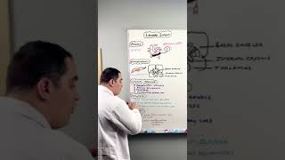 Ischemic Stroke  Lacunar Infarct shorts [upl. by Nikral]