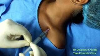 Devendras Infraclavicular Pediatric Brachial block [upl. by Gambell710]