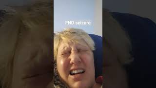 FND seizure aka non epileptic seizure functional neurological disorder [upl. by Allegra]