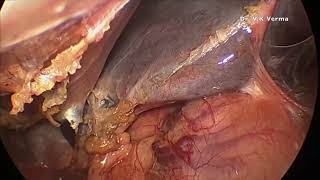 Laparoscopic cholecystectomy [upl. by Aneez]