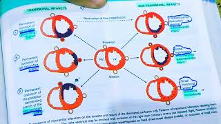 Myocardial Infarction pathologyAnterior wall MISTEMI AND NSTEMIHeart pathologyRobbins pathology [upl. by Olag233]