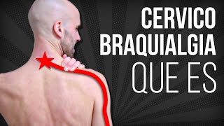 ⚡CERVICOBRAQUIALGIA que es por que se produce y cual es su TRATAMIENTO [upl. by Karola282]