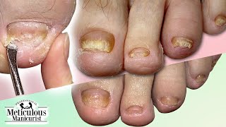 CUTICLE Cleaning on FUNGAL TOENAILS Transformation [upl. by Enid]