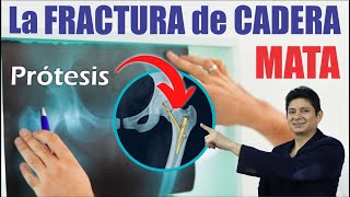 La FrACTUrA de CAdERa MaTa 🦴 Tipos de Cirugía con PRÓTESIS ⭐ Dr WALTER ALVARADO Traumatología 24 hrs [upl. by Violetta]