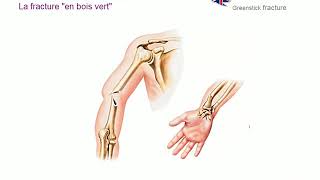 Les différents types de fractures [upl. by Neiluj]