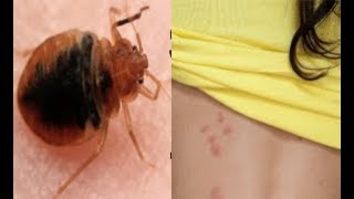 Do You Have Bed Bug Bites 5 Bed Bug Bite Symptoms to Check for [upl. by Sredna313]