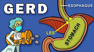 Gastroesophageal Reflux Disease GERD [upl. by Eenaj]