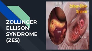 Zollinger ellison syndrome  ZES [upl. by Gilberto189]