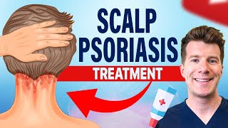 Doctor explains FOUR TREATMENTS for SCALP PSORIASIS [upl. by Galen]