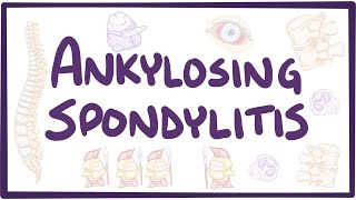 Ankylosing spondylitis  causes symptoms diagnosis treatment pathology [upl. by Burrell]