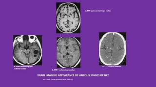 Neurology Quiz 20 Topics Neurocysticercosis NCC and drug induced myopathies [upl. by Esinev]