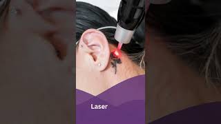 Laser Tattoo Removal amp Skin Treatments in Surat Gujarat  Callisto Clinic by Dr Rushin Thakor [upl. by Moriarty458]