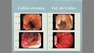 Colitis ulcerosa Vs Enfermedad de Crohn [upl. by Stelu]