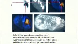 PET Scan in Orthopaedics [upl. by Felty]