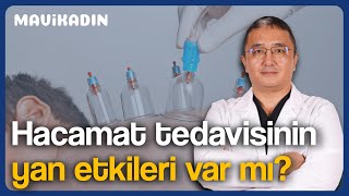 Hacamat Hangi Hastalıklara Yapılır Hacamatın Faydaları Yan Etkileri Zamanı  Mavi Kadın [upl. by Sauer]