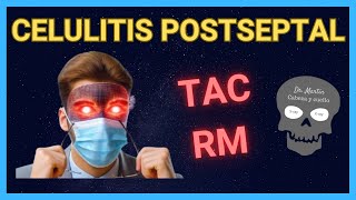 CELULITIS POSTSEPTAL Signos Radiológicos 👀 [upl. by Dnyletak]