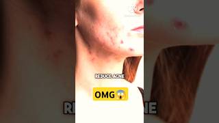 Mukha ma kalo dag pimple chha vane 10 din ma hataunu hos yasri😱trending amazing video subscribe [upl. by Gnirol]