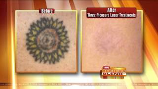 Removing Tattoos Quickly amp Effectively [upl. by Malin1]