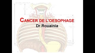 Canser de loesophage  Dr Rouainia [upl. by Ahsennek]