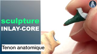 Inlaycore tenon anatomique  Prothèse inamovible  Prothèse dentaire  © [upl. by Sucirdor]