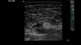 Ultrasound guided Infragluteal Sciatic Nerve Blockmov [upl. by Eener]