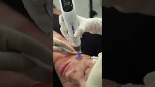 PRP  Microneedling with Dermapen [upl. by Ettenom]