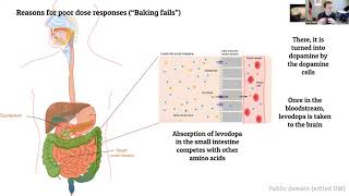 Advanced Therapies Panel Series Duodopa® [upl. by Nastassia514]