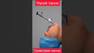 THYROID CANCER  THYROID REMOVAL 3D ANIMATION biologyislife howtogetsuccessinlife getsuccess [upl. by Enecnarf]