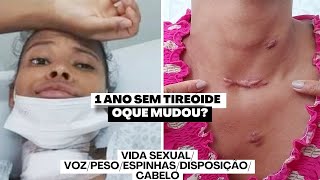 COMO É VIVER SEM TIREOIDE   1 ANO DE TIREOIDECTOMIA  CÂNCER NA TIREOIDE [upl. by Moreville]