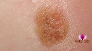 Melanoma Pictures  Signs Symptoms Causes Photos Images Pictures of Melanoma Skin Cancer [upl. by Oflodor]