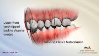 Malocclusion  Class II Div 2 [upl. by Pelaga]