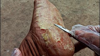 Ultimate Foot Scraping Transformation for an Australian Man [upl. by Hairom423]