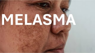 Melasma মাইহীঙ [upl. by Leinahtam614]