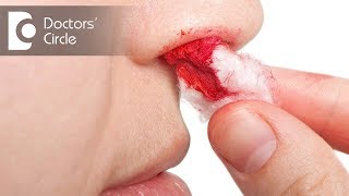 Understanding Nose Bleed or Nasal Bleeding  Dr Dilip Kumar Dash  CARE Hospitals HITEC City [upl. by Odrude]