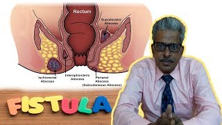 Fistula  Discussion and Remedy in Homeopathy by Dr PS Tiwari [upl. by Yenaffit]