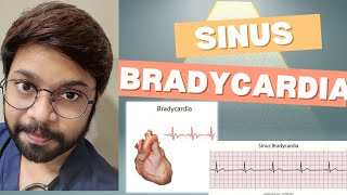 Sinus Bradycardia [upl. by Jdavie]