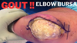 Elbow Olecranon Bursitis Gout Treated in 3 minutes [upl. by Rettig]