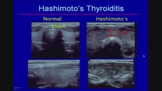 Sonographic Evaluation of Diffuse Thyroid Disease [upl. by Elburt]