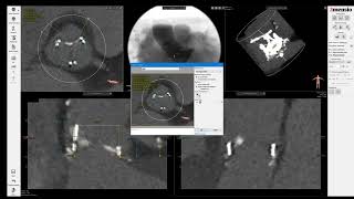 3Mensio CT precase planning ValveinValve TAVR in PerimountMagna Surgical Aortic Valve SAV [upl. by Gilboa92]