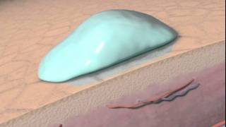 The Science behind Personal Microderm and microdermabrasion with animation [upl. by Kalikow210]